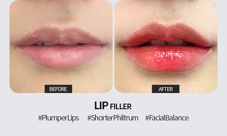 Signature filler treatment