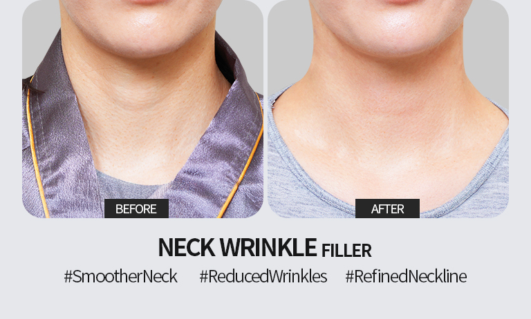 Signature filler treatment