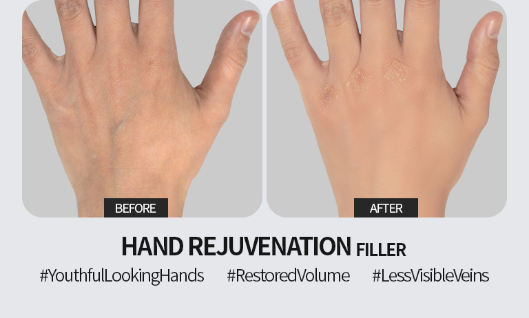 Signature filler treatment